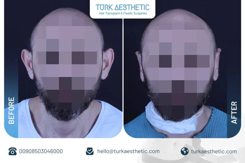 اصلاح گوش قبل و بعد عمل