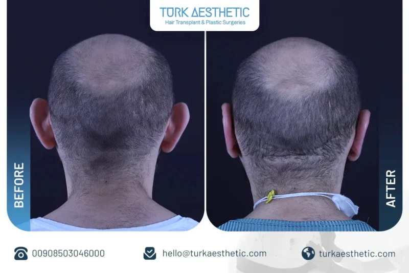 جراحی گوش قبل و بعد در ترکیه نتایج طبیعی