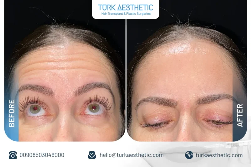 Résultats du Botox du front