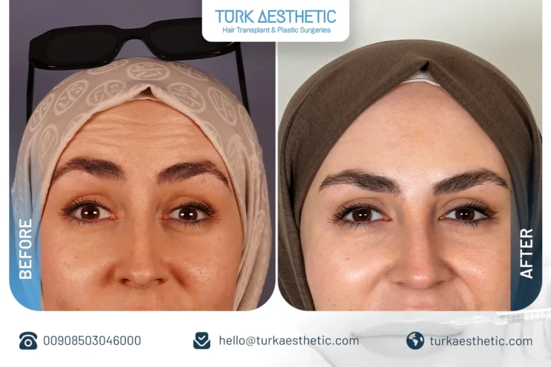 Résultats du Botox du visage