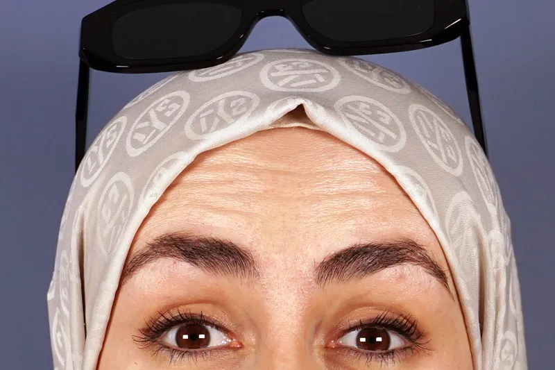 botoks öncesi alın kırışıklıkları