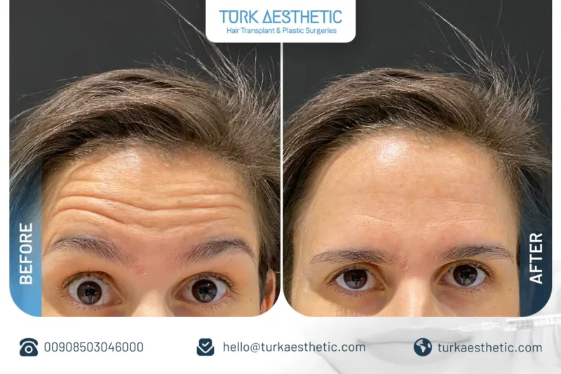 Résultats du Botox du contour des yeux