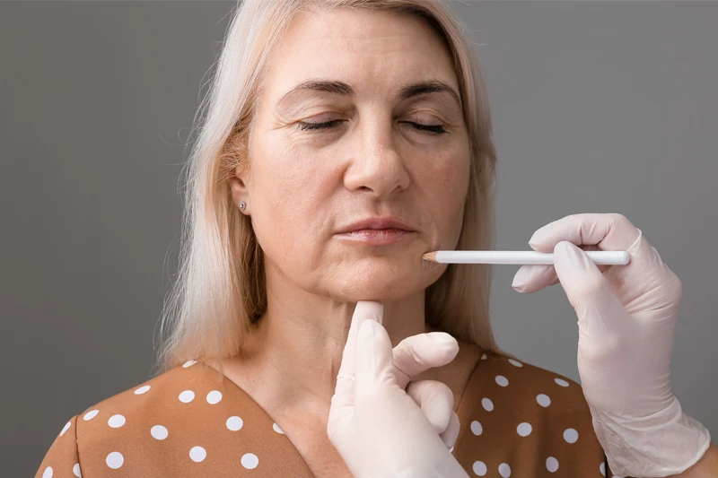 marionette çizgileri botoks tedavisi