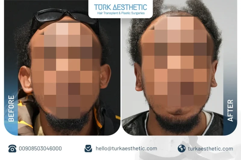 نتایج طبیعی جراحی گوش قبل و بعد