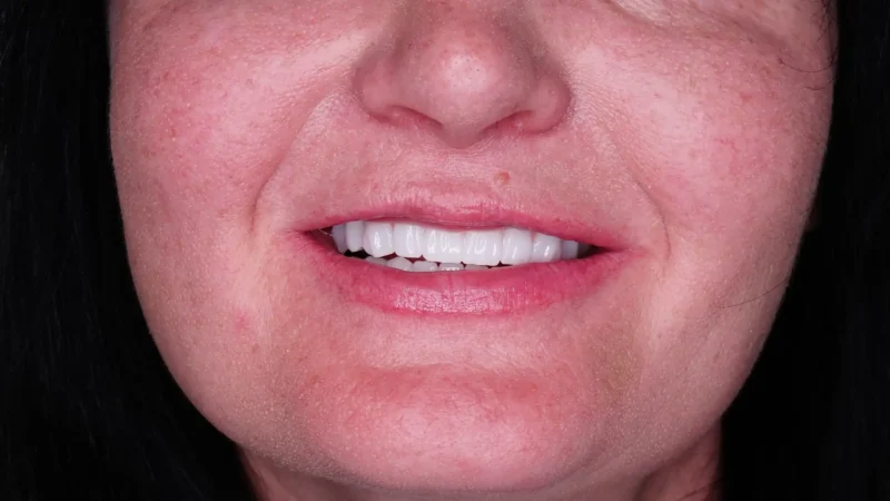 Diş estetiği ile gülüş tasarımı ve diş görünümünü iyileştirme işlemleri