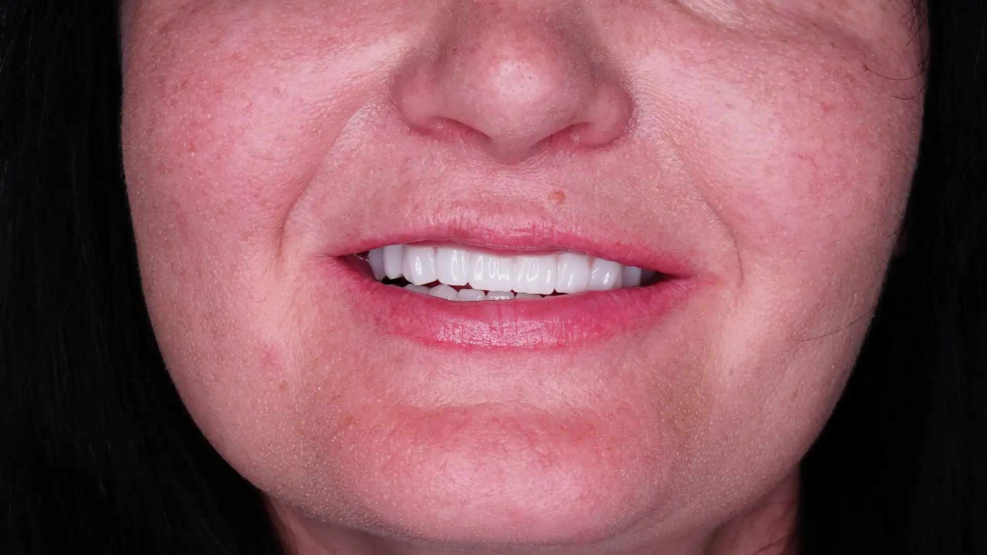 Diş estetiği ile gülüş tasarımı ve diş görünümünü iyileştirme işlemleri