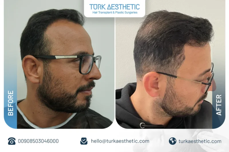 نتائج قبل وبعد زراعة الشعر بتقنية DHI مع فرق واضح في الكثافة والمظهر