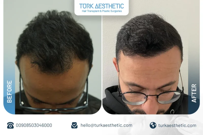 نتائج قبل وبعد زراعة الشعر بتقنية DHI مع زيادة واضحة في كثافة الشعر