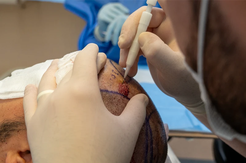 مرحلة زرع بصيلات الشعر مباشرة باستخدام تقنية DHI