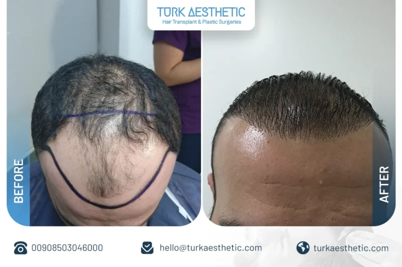 نتائج قبل وبعد زراعة الشعر بتقنية DHI في منتصف الرأس مع تحسن الكثافة