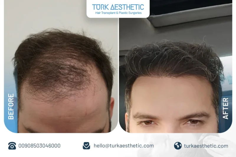 نتائج قبل وبعد زراعة الشعر بتقنية DHI في الجزء العلوي مع تحسن الكثافة