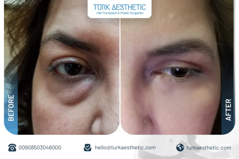 chirurgie des paupières avant après résultat naturel