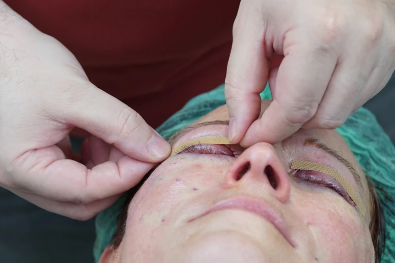 göz kapağı estetiği sonrası estetik dikiş kapatma aşaması