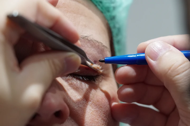 göz kapağı estetiği öncesi muayene ve hazırlık aşaması