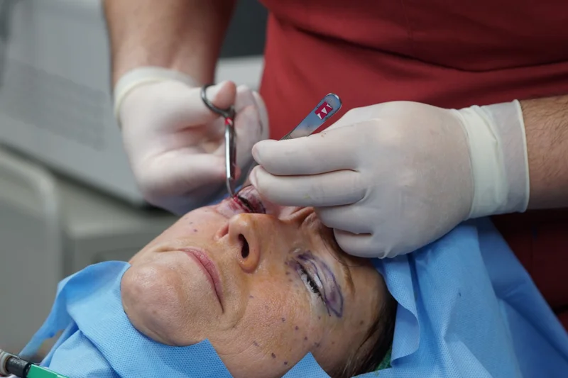 göz kapağı estetiği yağ ve deri düzenleme aşaması