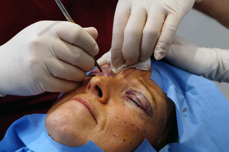 göz kapağı estetiği cerrahi kesi aşaması