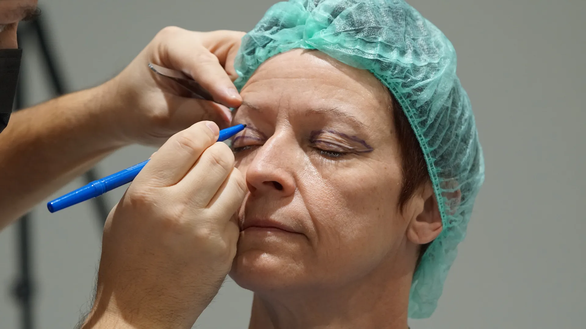 marquage avant chirurgie des paupières sur le visage