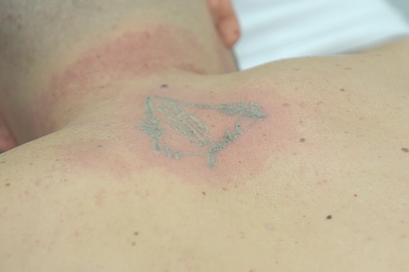 lazer sonrası dövmenin solması ve azalma sonucu