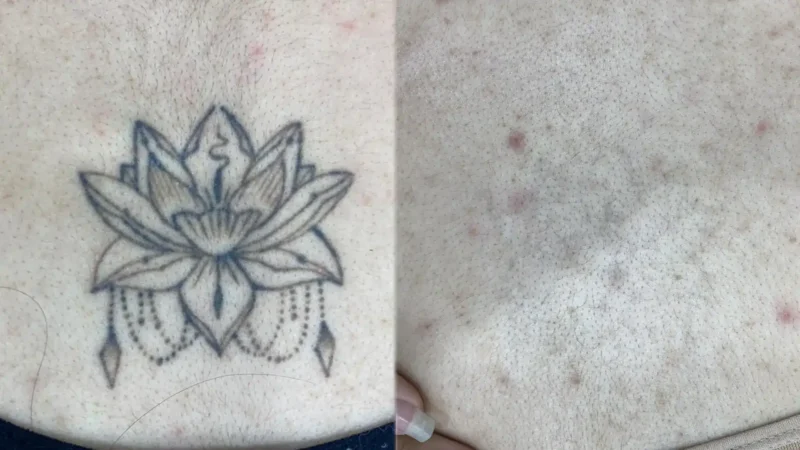 lazerle dövme silme öncesi ve sonrası sonucu, dövmenin belirgin şekilde solması