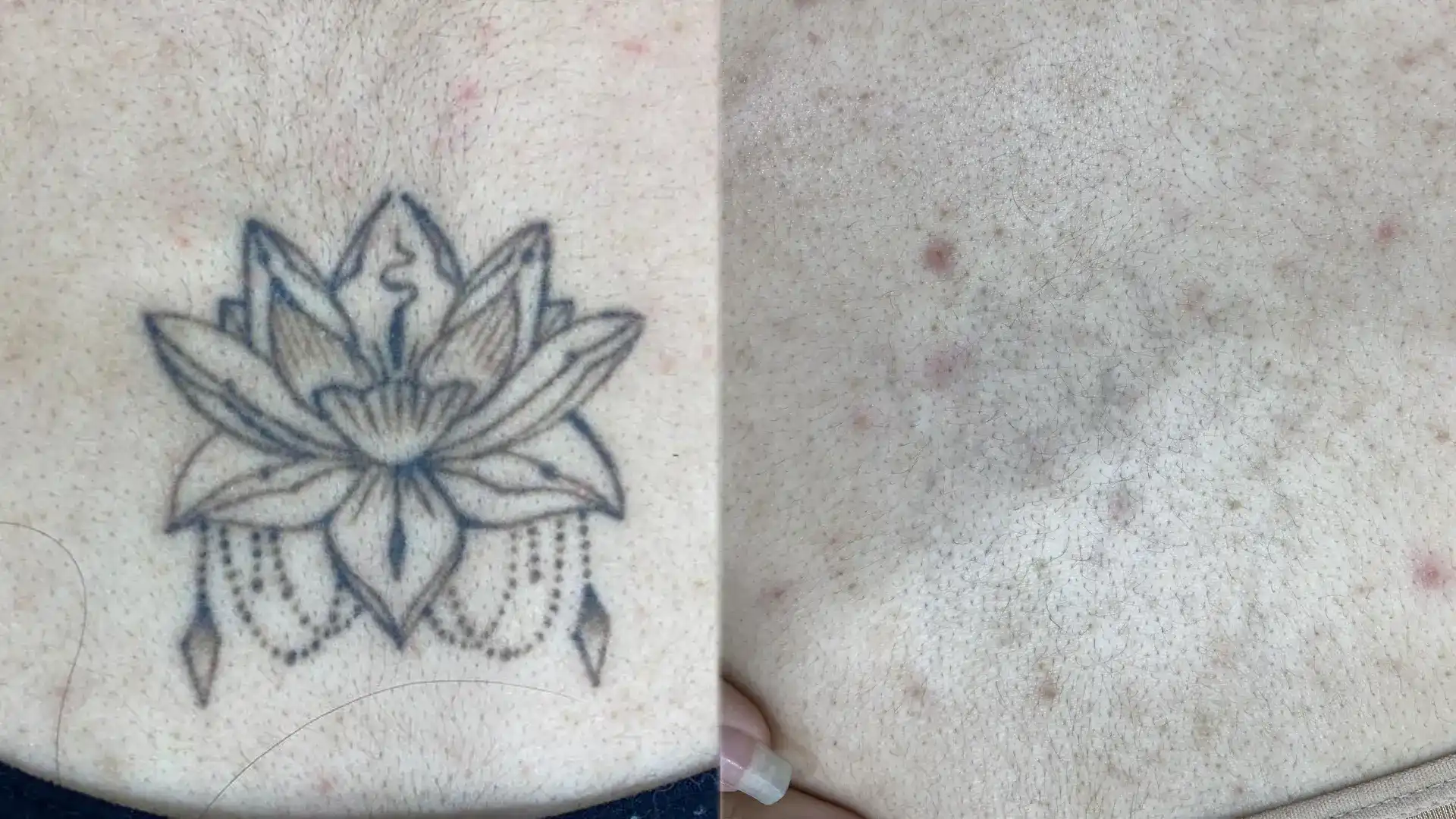 lazerle dövme silme öncesi ve sonrası sonucu, dövmenin belirgin şekilde solması