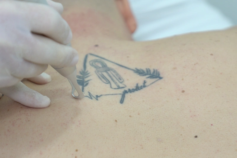 lazer tedavisi öncesi dövmenin görünümü