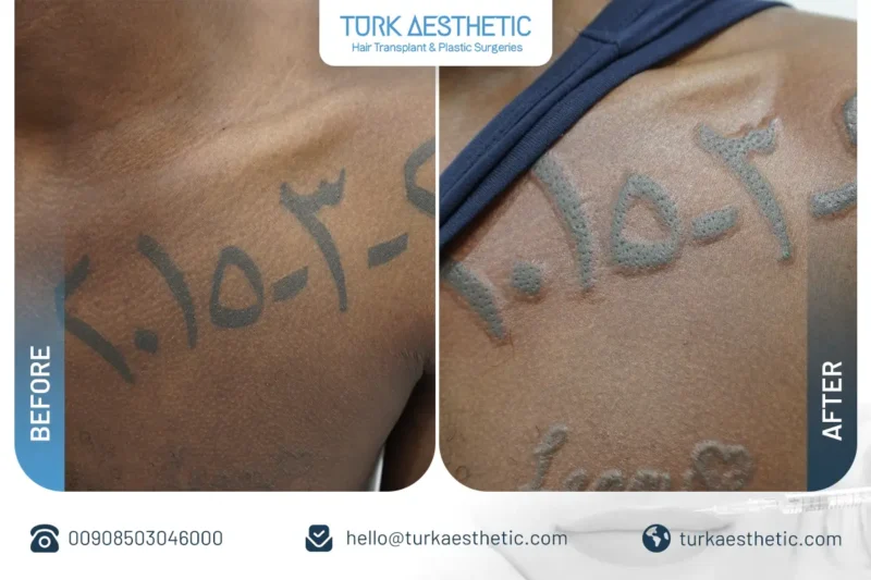Türkiye’de lazerle dövme silme öncesi ve sonrası göğüste Arapça tarih dövmesi sonucu