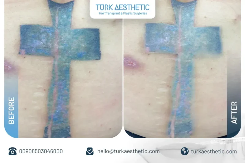 Türkiye’de lazerle dövme silme öncesi ve sonrası karında haç dövmesi sonucu