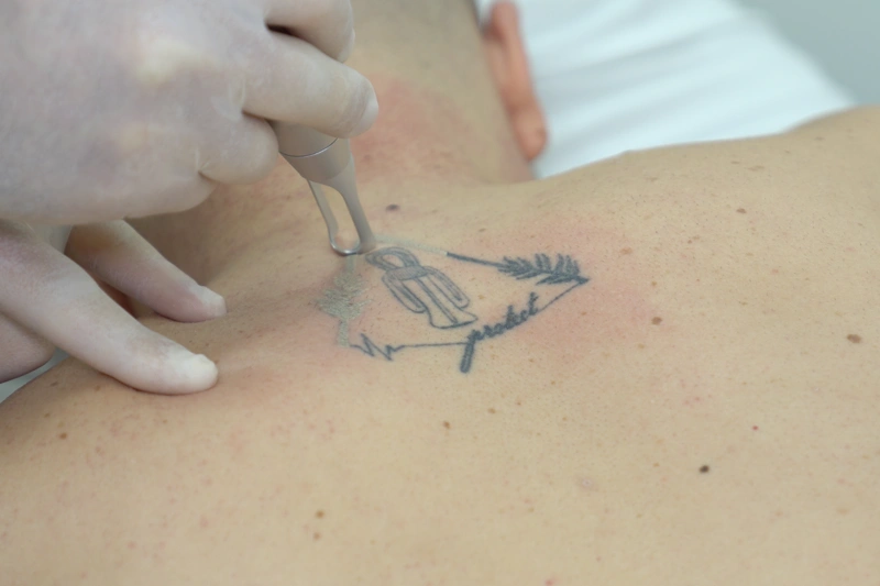 lazerle dövme silme işlemi sırasında uygulama nd yag