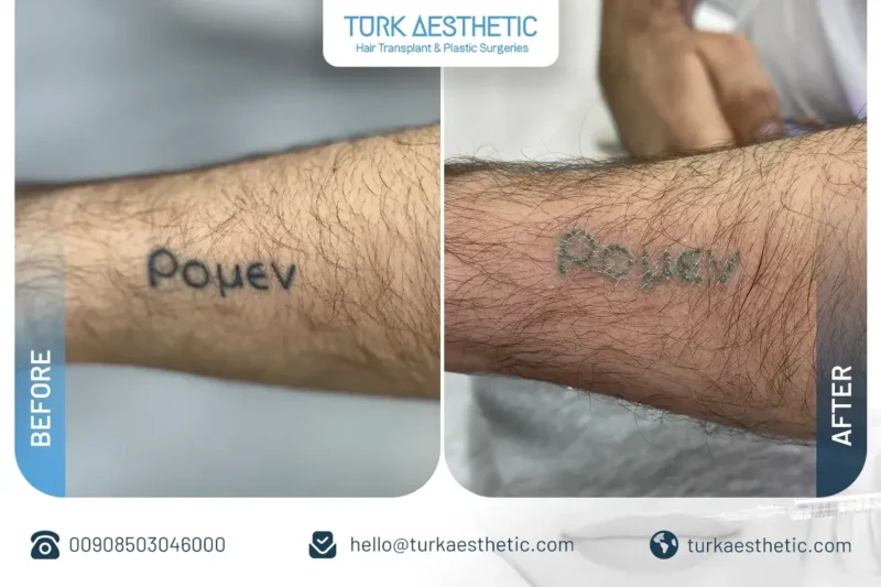 Türkiye’de lazerle dövme silme öncesi ve sonrası ön kolda yazı dövmesi sonucu