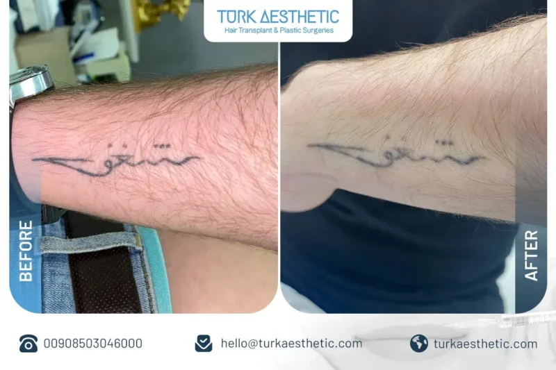 Türkiye’de lazerle dövme silme öncesi ve sonrası ön kolda metin dövmesi sonucu