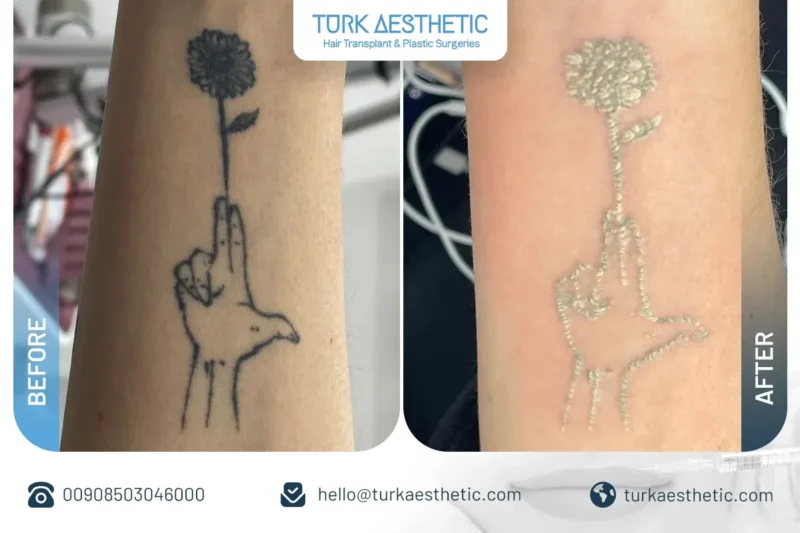 Türkiye’de lazerle dövme silme öncesi ve sonrası el ve gül dövmesi sonucu