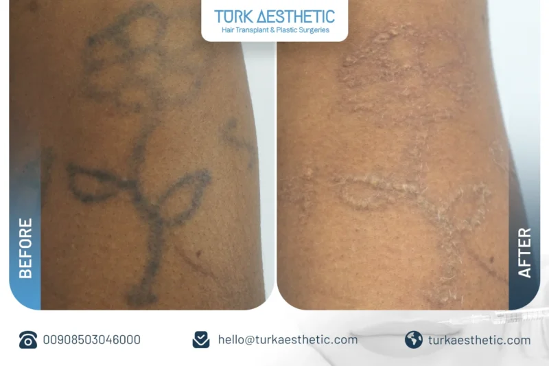 Türkiye’de lazerle dövme silme öncesi ve sonrası elde eski gül dövmesi sonucu