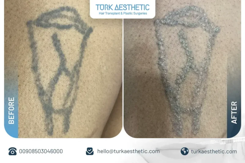 Türkiye’de lazerle dövme silme öncesi ve sonrası bacakta eski gül dövmesi sonucu
