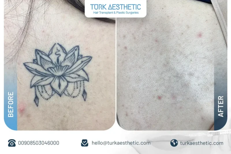 Türkiye’de lazerle dövme silme öncesi ve sonrası sırtta gül dövmesi sonucu