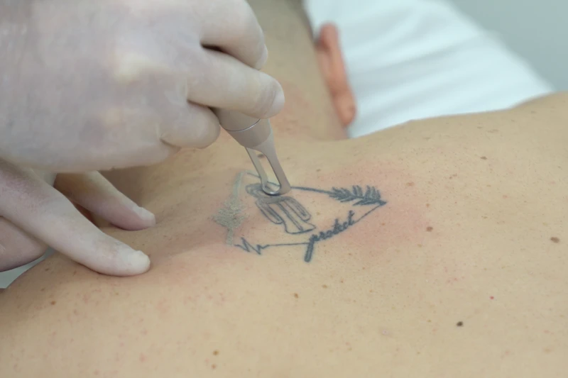 laser tattoo removal session showing treatment being applied on the skin