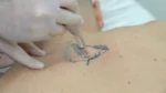 laser tattoo removal in turkey during session nd yag device treatment