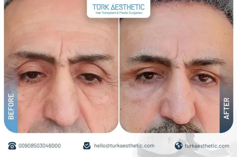 chirurgie de la paupière inférieure avant après élimination des poches sous les yeux