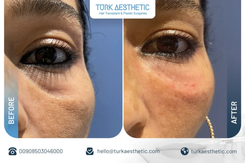 Risultati del filler del solco lacrimale prima e dopo in Turchia