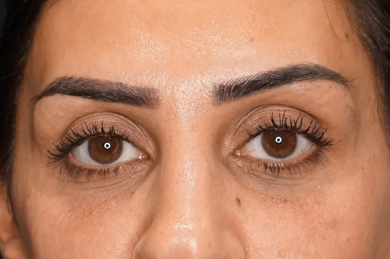 نتائج فيلر تحت العين بعد الإجراء بمظهر طبيعي