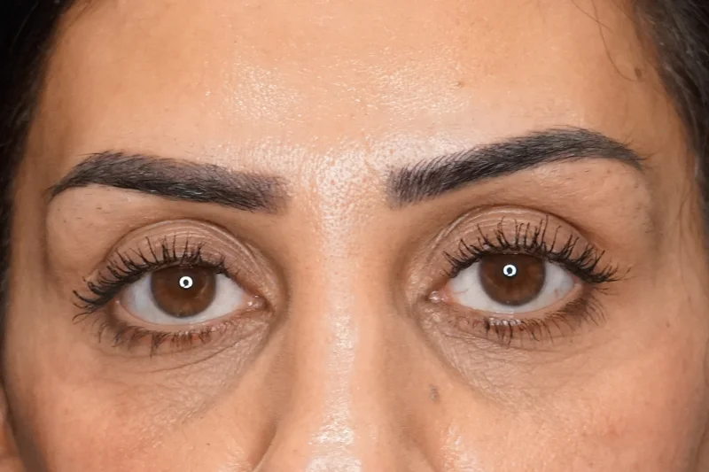 مظهر الهالات السوداء والتجويف قبل فيلر تحت العين