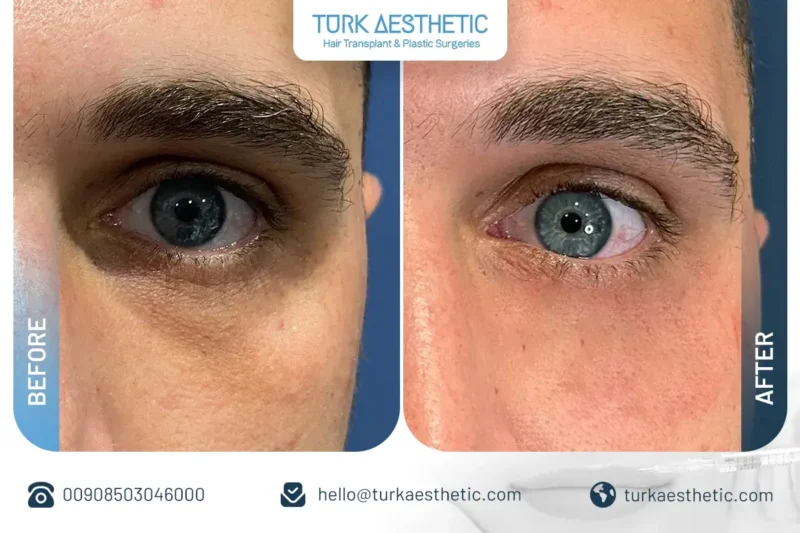Effetto illuminante del filler sotto gli occhi in Turchia
