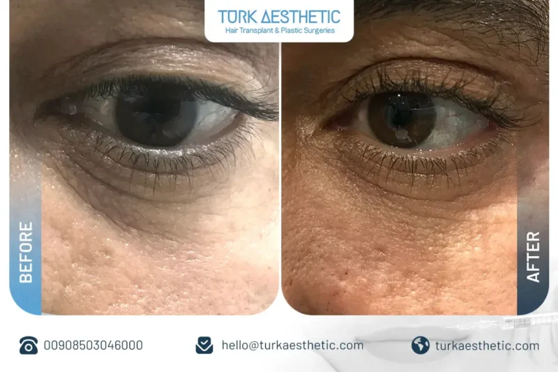 Filler sotto gli occhi prima e dopo per trattare le occhiaie in Turchia