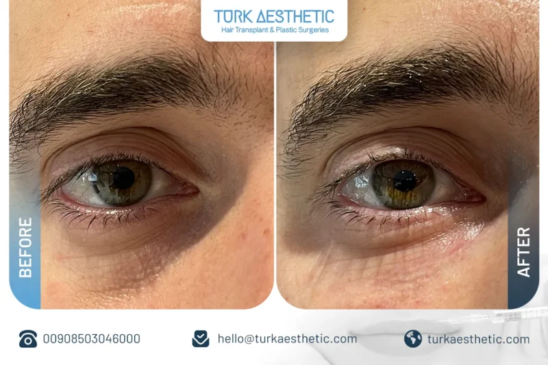 Risultati del filler sotto gli occhi per ridurre le borse in Turchia