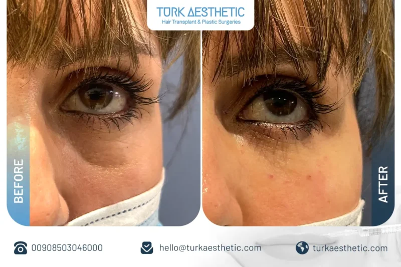 Risultati del filler sotto gli occhi per correggere gli avvallamenti in Turchia