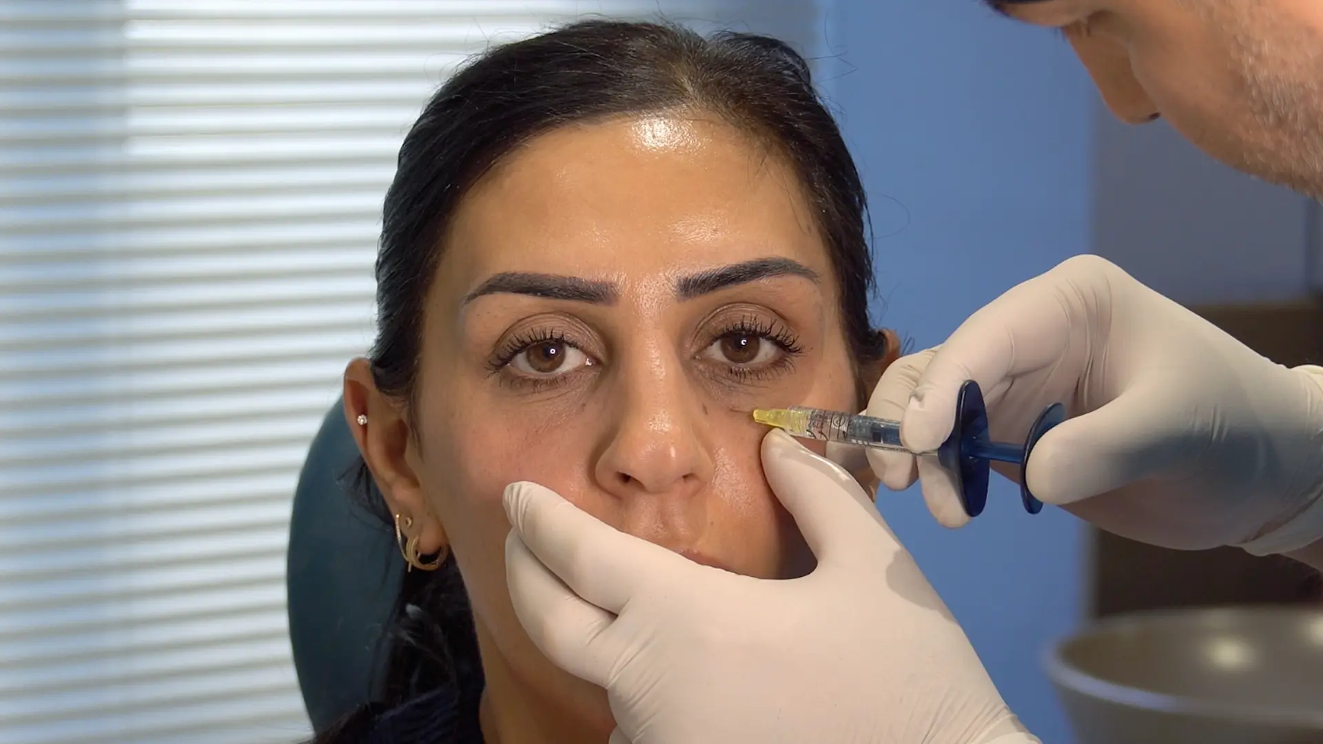 Under eye filler injection for dark circles and hollow eyes