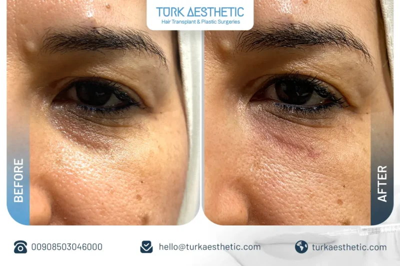 Risultati naturali del filler sotto gli occhi in Turchia