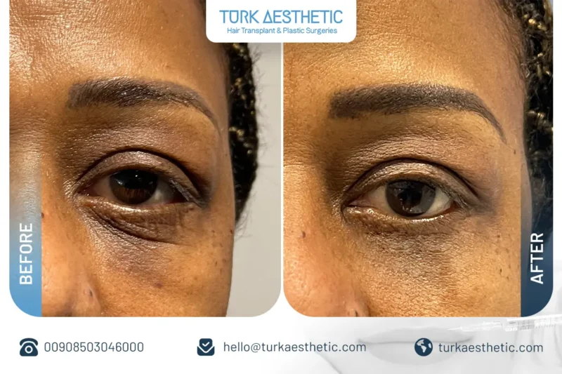 Filler sotto gli occhi in Turchia prima e dopo con risultati naturali