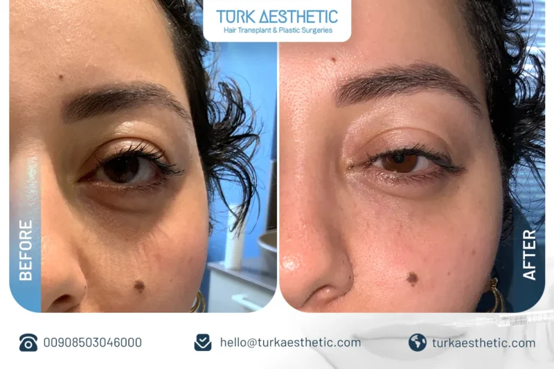 Risultati del filler sotto gli occhi in Turchia con miglioramento visibile