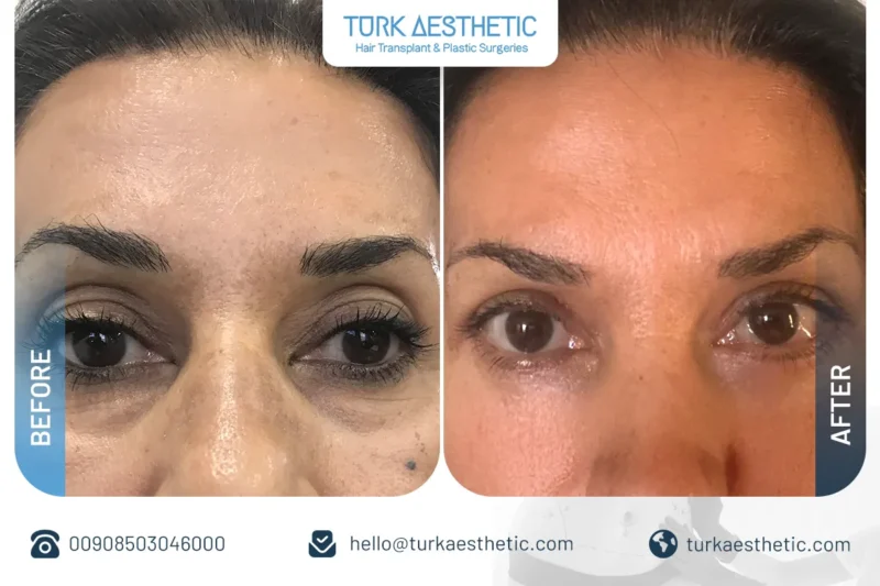 chirurgie de la paupière supérieure avant après correction du relâchement