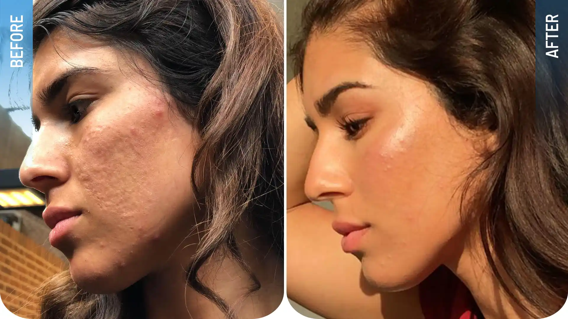 CO2 fraksiyonel lazer öncesi ve sonrası sonucu